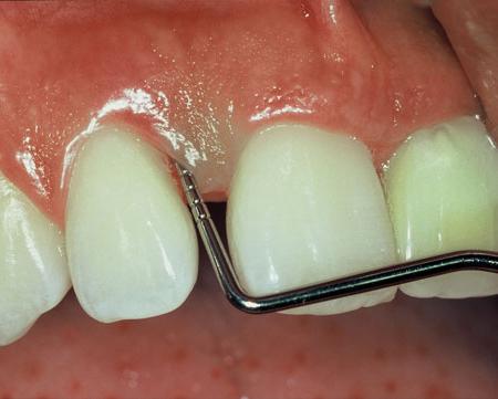 Chronická a akutní periodontida: příznaky, léčba a příčiny