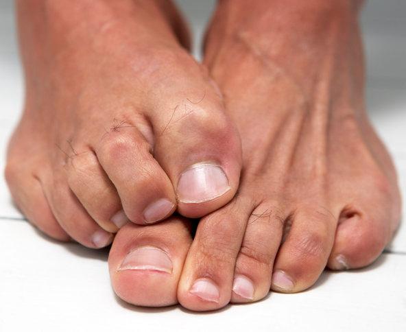 Nezdravá houba na nehty nohou: léčba lidovými prostředky